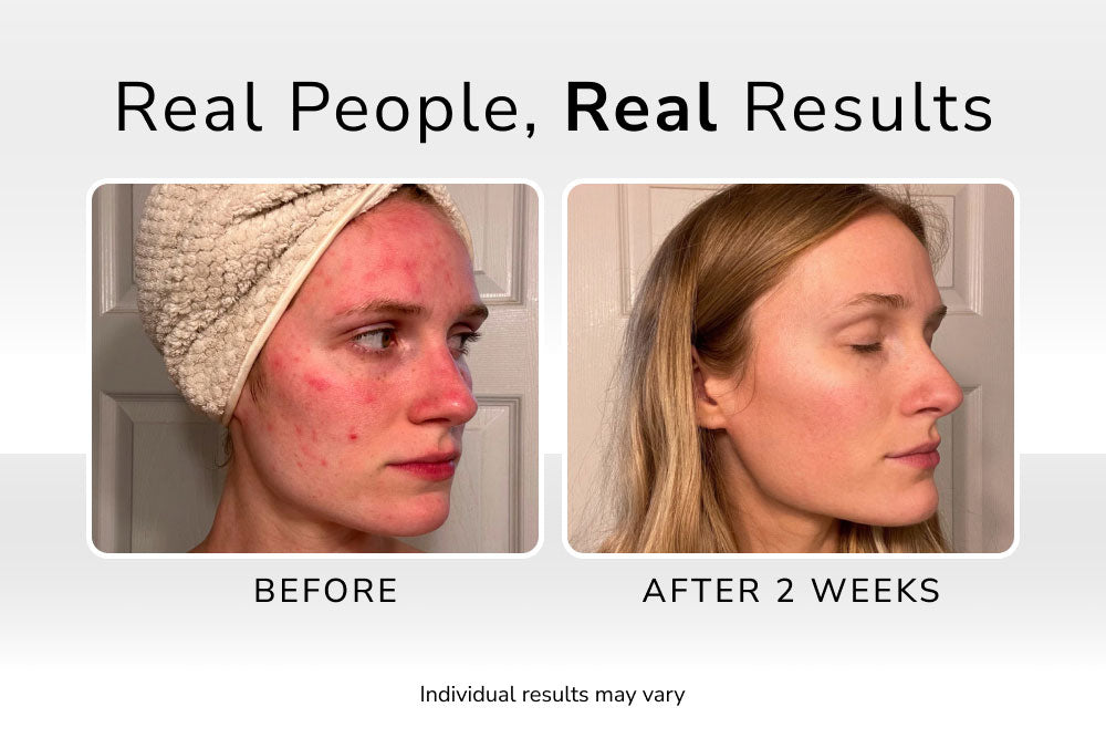 Results using the Red Light Face Mask